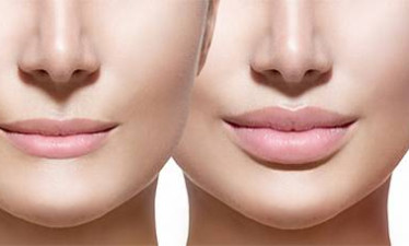 Контурна пластика губ (роботи до та після)